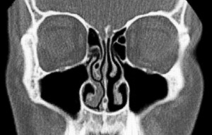 Immagine che mostra l'evidenza del ciclo nasale. La parte decongestionata è a destra; La parte con i turbinati gonfi è a sinistra.Fonte: http://it.wikipedia.org/wiki/Ciclo_nasale